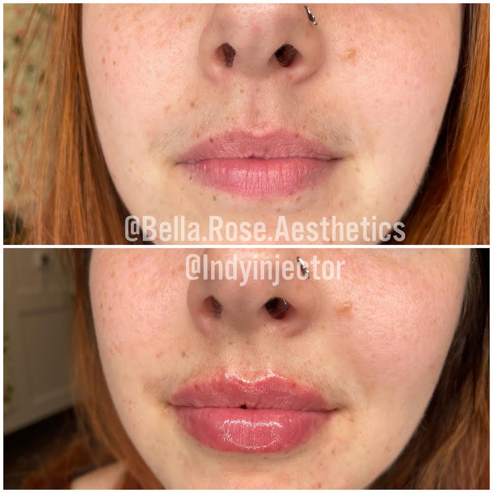 Before and After | Bella Rose Aesthetics | Carmel IN