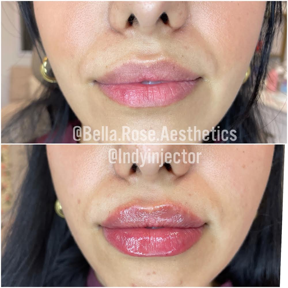 Before and After | Bella Rose Aesthetics | Carmel IN