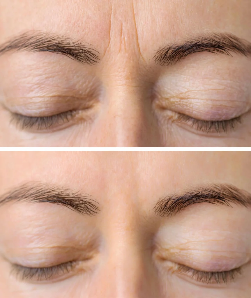 Dysport Treatment in Carmel Indiana | Bella Rose Aesthetics